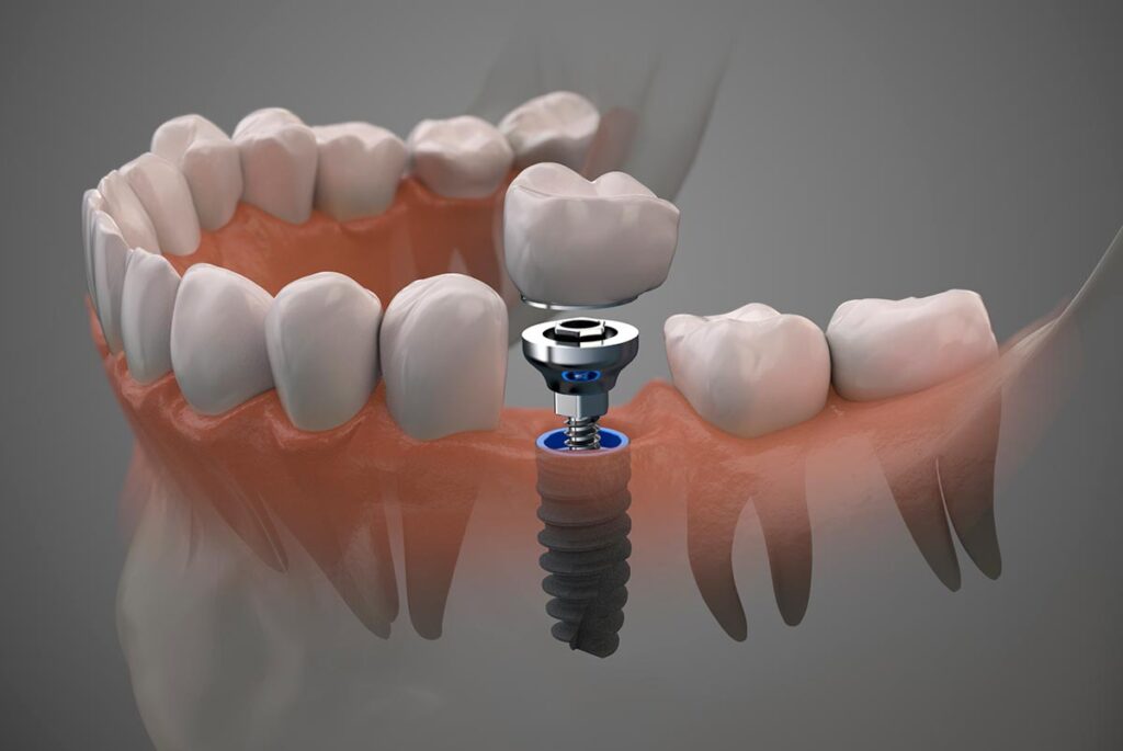 ¿Cuánto cuesta un implante dental en Murcia?