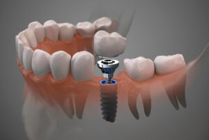 ¿Cuánto cuesta un implante dental en Murcia?