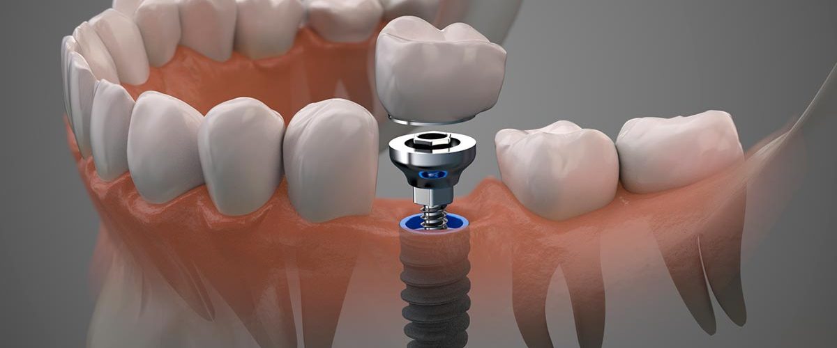 ¿Cuánto cuesta un implante dental en Murcia?